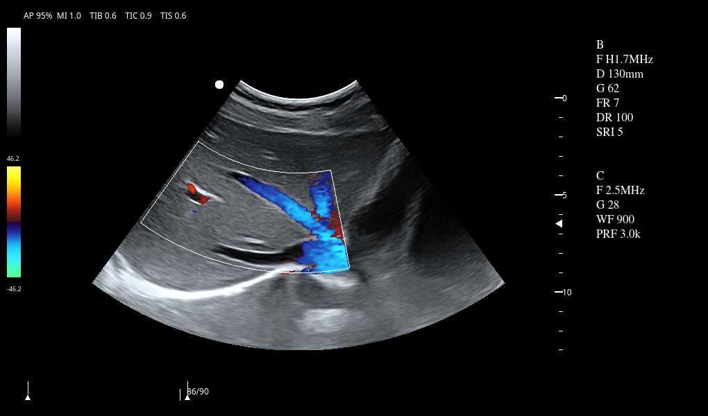 Hepatic vein C mode1