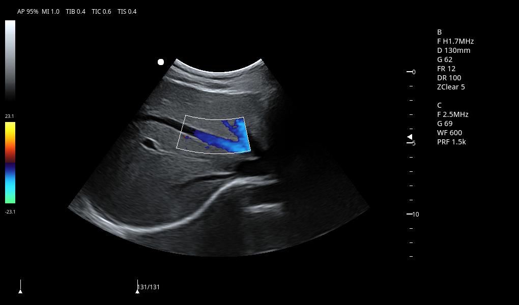 Hepatic vein C mode2