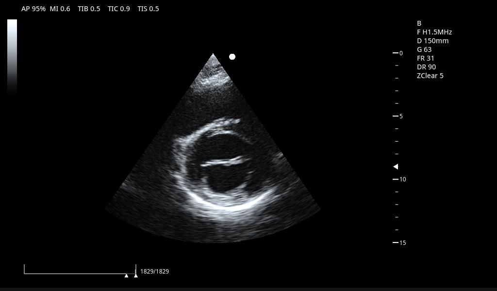Cardiac LV short axis